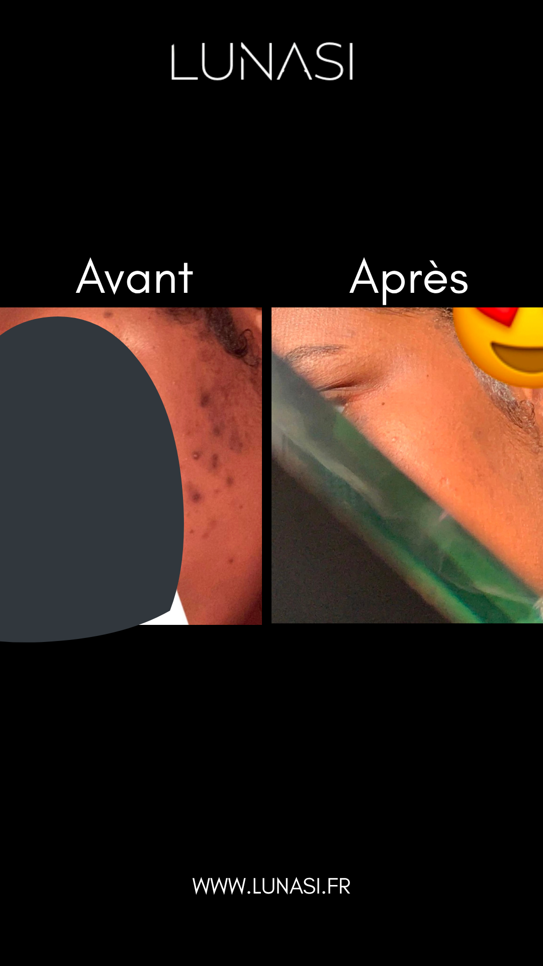 PERFECT SKIN TREATMENT - TRIO TRAITEMENT 30 jours.