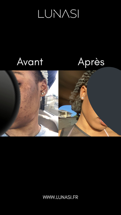 PERFECT SKIN TREATMENT - TRIO TRAITEMENT 30 jours.